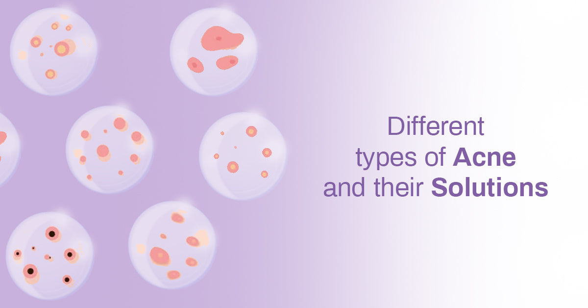 Different Types of Acne and Their Solutions