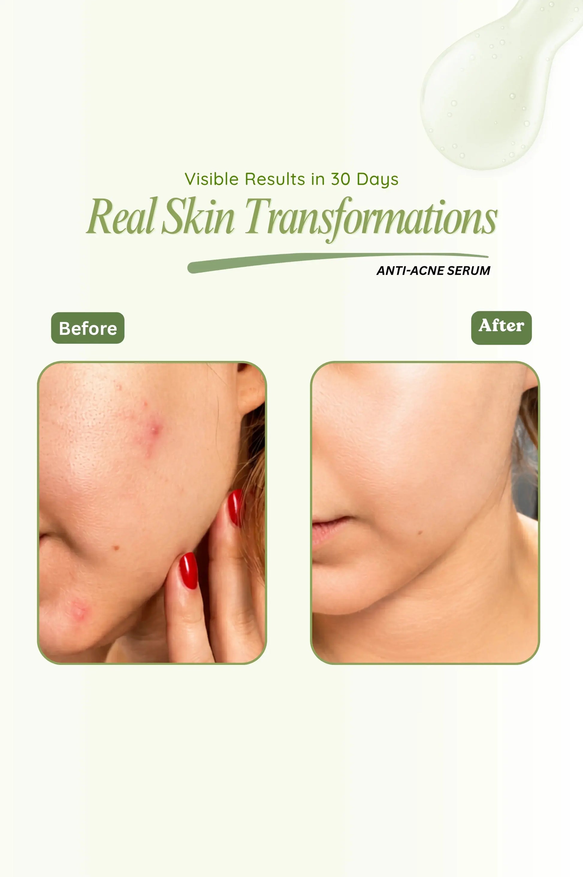 Before and after comparison of skin with anti-acne serum showing visible results.
