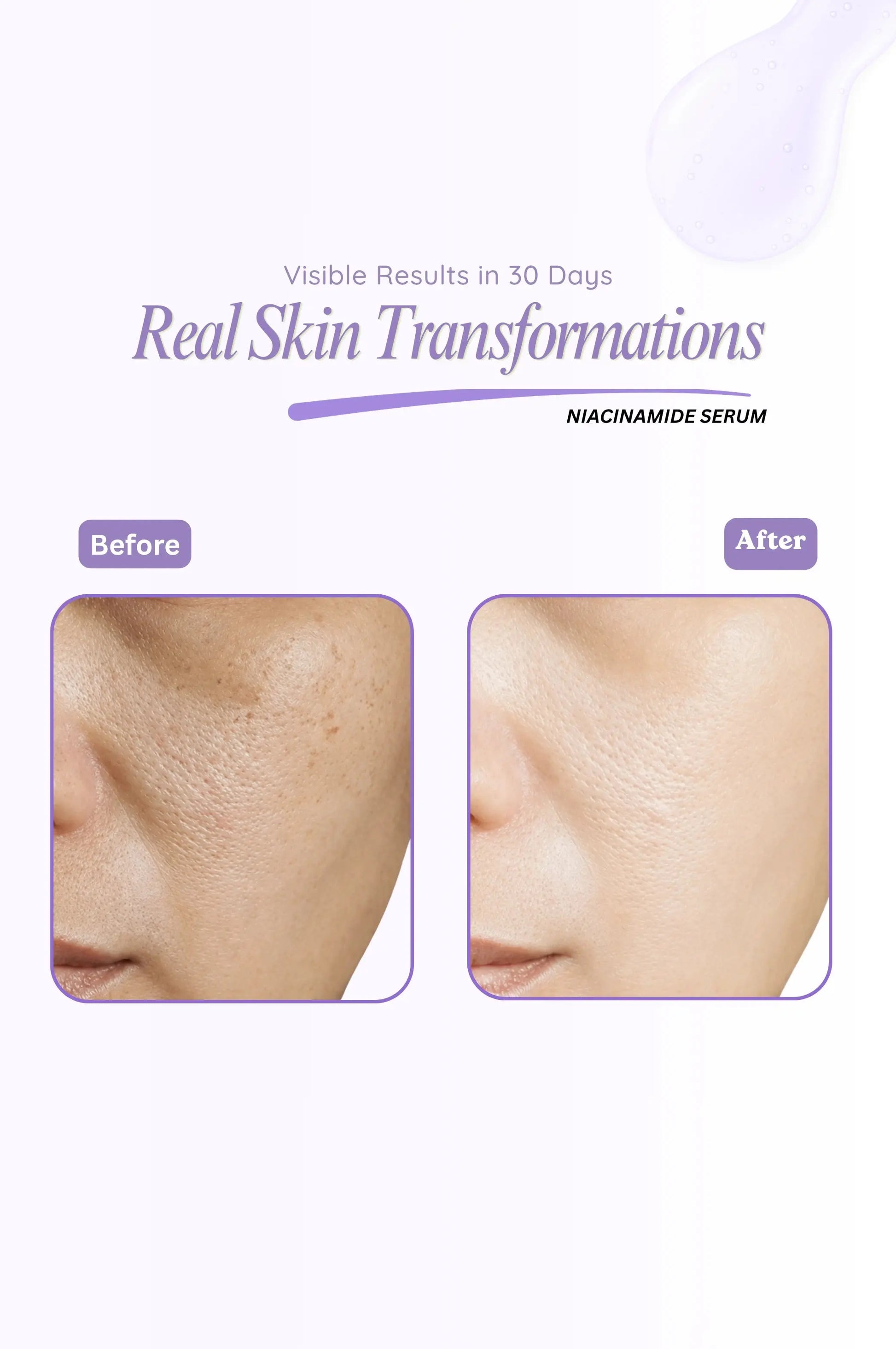 Before and after comparison of skin treatment with visible results in 30 days, featuring niacinamide serum.